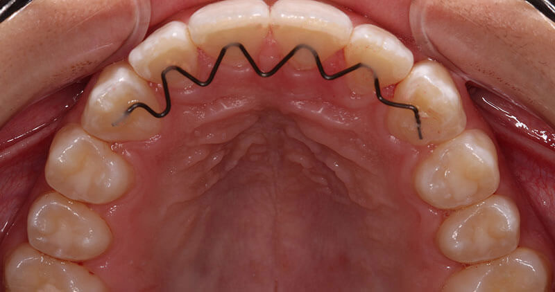 Orthodontics Dentistry Gallery – Picnic Point Dental